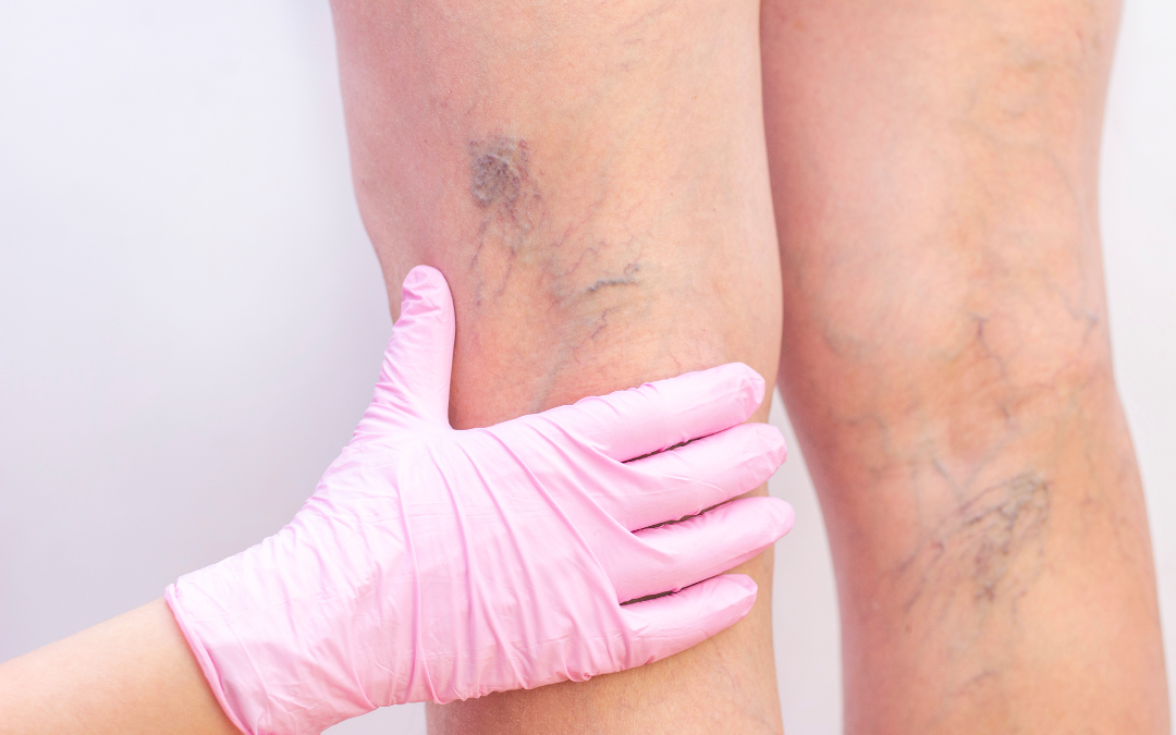 spider veins on back of legs