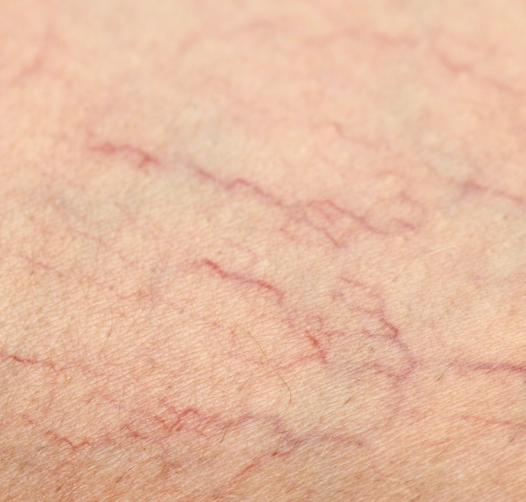 back of female legs with spier veins