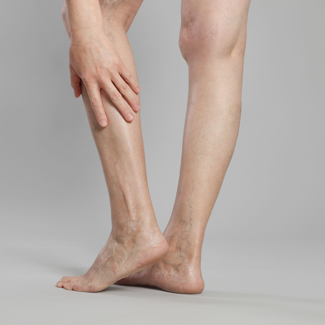 female legs showing spider veins